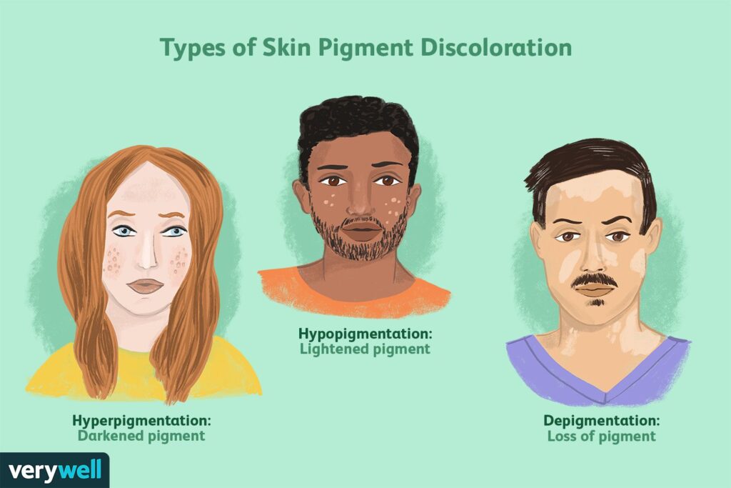 ¿Qué causa los parches de piel descolorida?